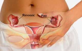 Химиотерапия при раке яичников в клиниках Израиля