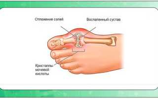 Как вывести соли мочевой кислоты из суставов