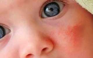 Атопия — это что такое? Фото, признаки, лечение кожи