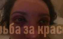 Отзывы о неудачной блефаропластике верхнего и нижнего века