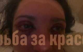 Отзывы о неудачной блефаропластике верхнего и нижнего века