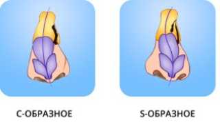 Операция по исправлению перегородки носа, кому она необходима?