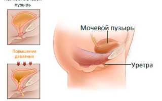Операции по поводу недержания мочи