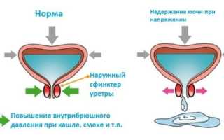 Мочеиспускание при кашле у женщин: лечение и упражнения 2019