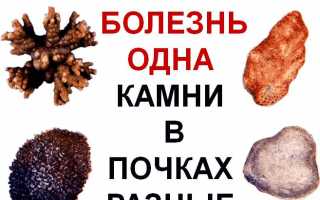 Диета при мочекаменной болезни у мужчин и женщин: правильное питание при болезни почек, какие продукты можно есть и что нельзя кушать