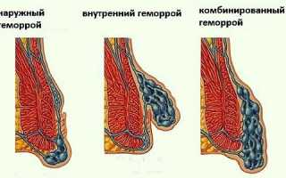Воспаляется геморрой во время месячных: причины и что делать?
