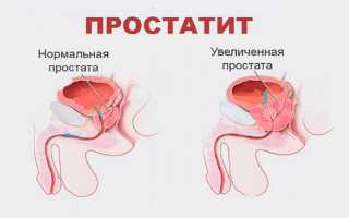 Урологический пластырь для мужчин Zb Prostatic Navel Plaster (отзывы врачей)