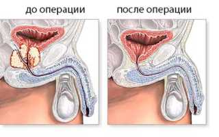 Сколько длится операция по урологии
