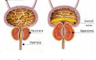 Симптомы рака предстательной железы у мужчин