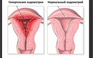 Что такое фиброзно-железистый полип цервикального канала — 6 методов удаления и лечение после оперативного вмешательства