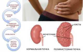 Поликистоз яичников теперь стало возможно вылечить!